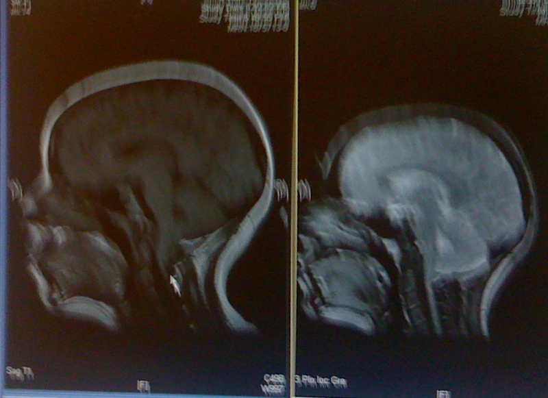 Illustration for article titled Ask Someone Who Had Brain Surgery